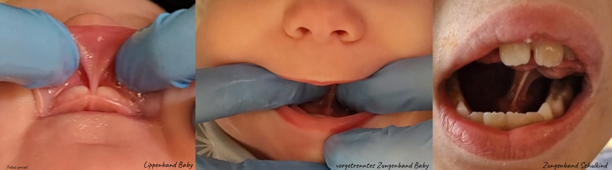 Zungenband und Lippenband beim Baby und Kind – Zungenbandberatung in Dresden und Radebeul